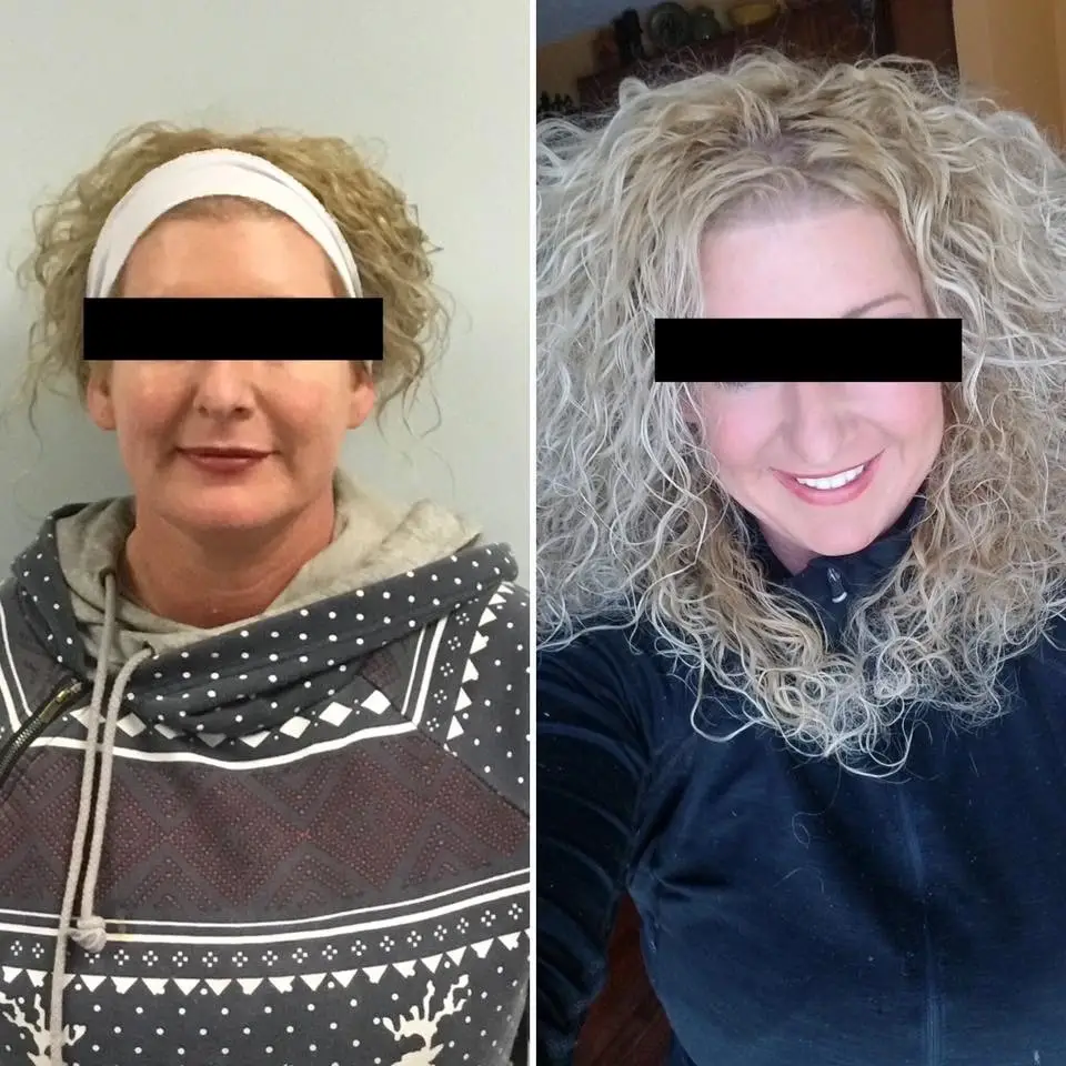 before and after Cyro-T shock weight loss treatment showing difference in face fat on woman.