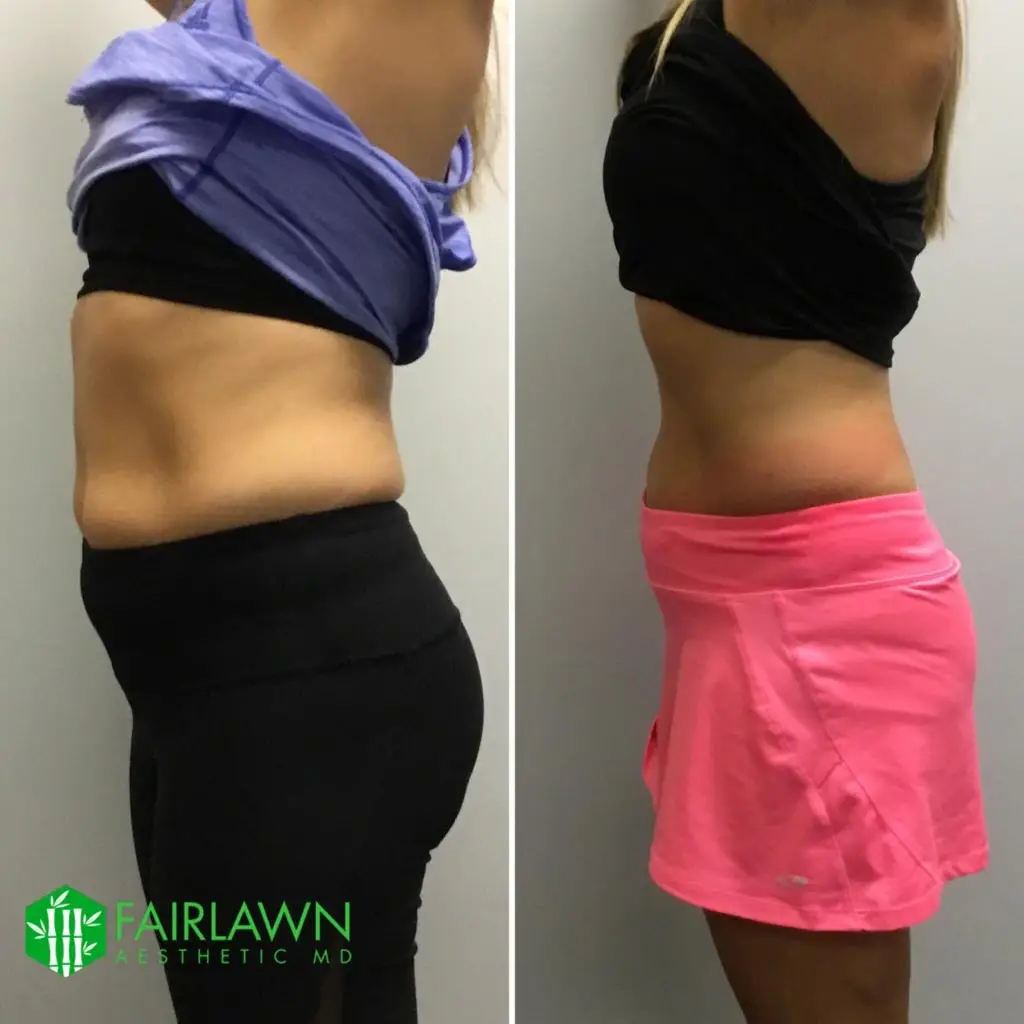 before and after images of Cryo-T weight loss. before has woman showing her large stomach, while after has her stomach shrinked